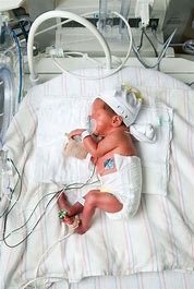 A baby cared for in the NICU